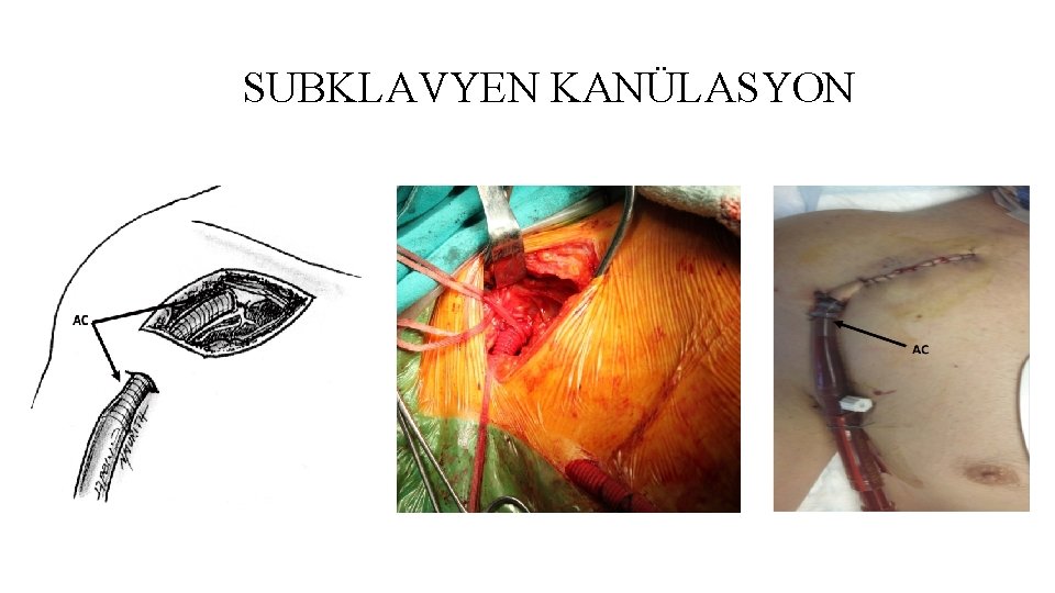 SUBKLAVYEN KANÜLASYON SUBKLAVYEN KANÜLASYON