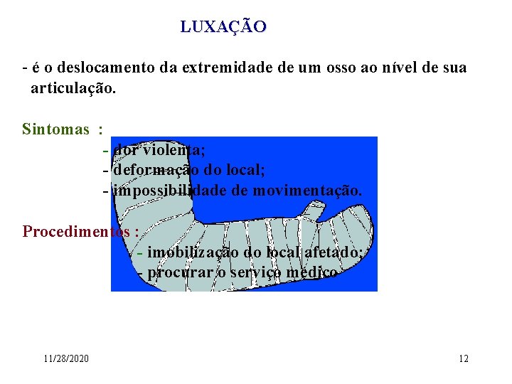 LUXAÇÃO - é o deslocamento da extremidade de um osso ao nível de sua