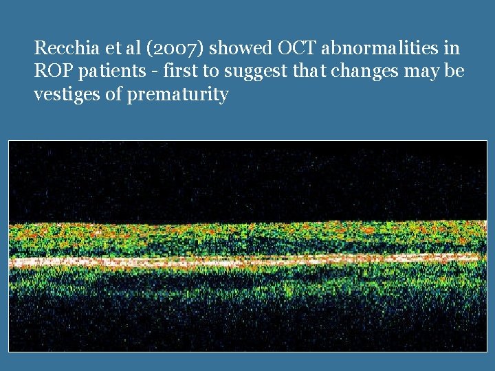 Oct And Rop A spectraldomain OCT study of formerly premature children