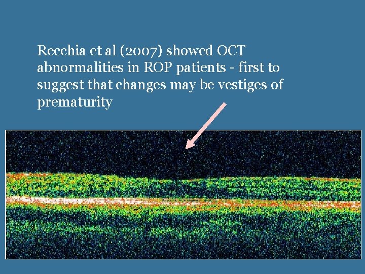 Recchia et al (2007) showed OCT abnormalities in ROP patients - first to suggest Recchia et al (2007) showed OCT abnormalities in ROP patients - first to suggest
