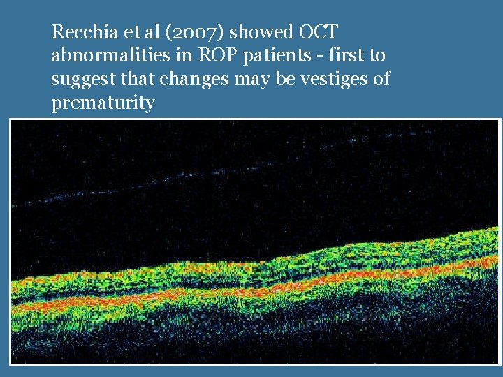 Recchia et al (2007) showed OCT abnormalities in ROP patients - first to suggest Recchia et al (2007) showed OCT abnormalities in ROP patients - first to suggest
