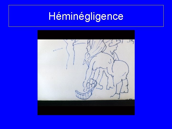 Héminégligence 