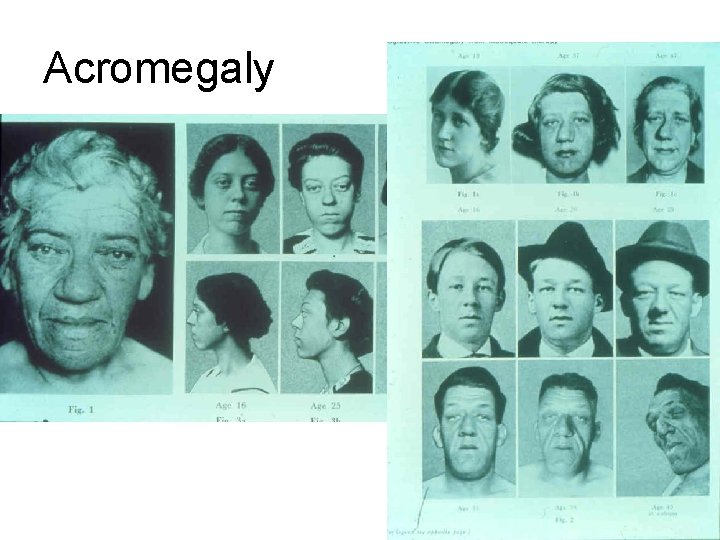 Acromegaly 