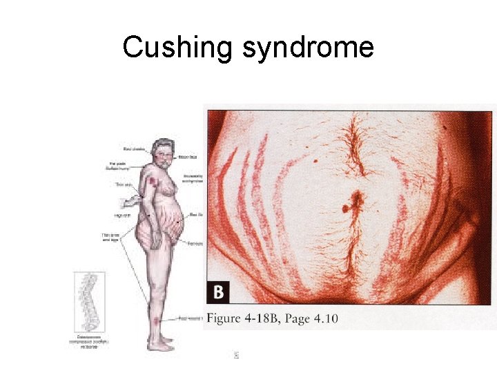 Cushing syndrome 