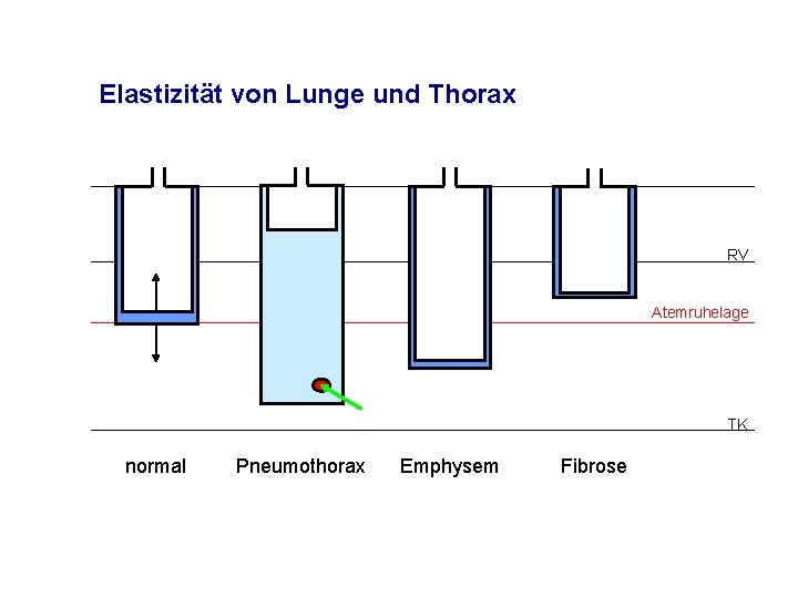 Elastizität von Lunge und Thorax RV Atemruhelage TK normal Pneumothorax Emphysem Fibrose 