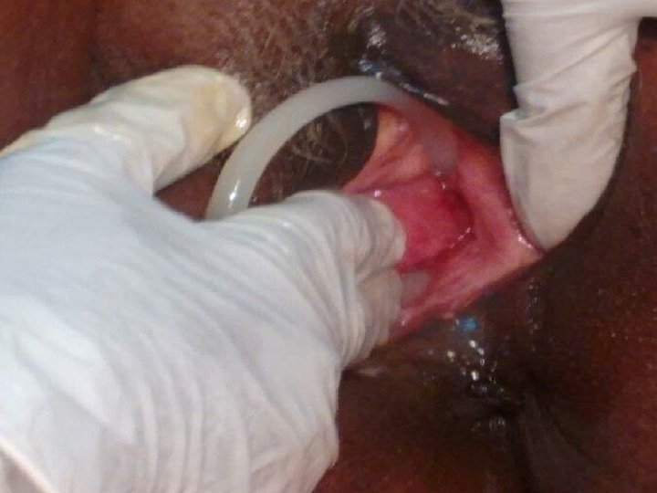 speculum examination revealed ring pessary was embedded in the lateral vaginal wall with a