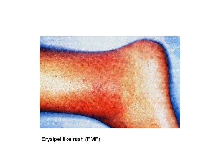 Erysipel like rash (FMF) 