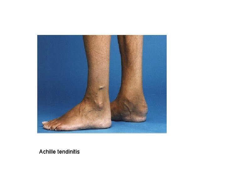 Achille tendinitis 