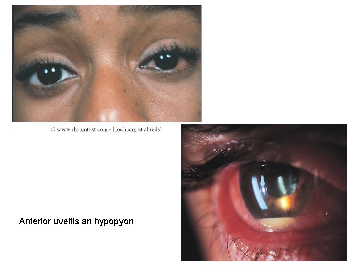 Anterior uveitis an hypopyon 