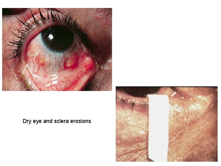 Dry eye and sclera erosions 