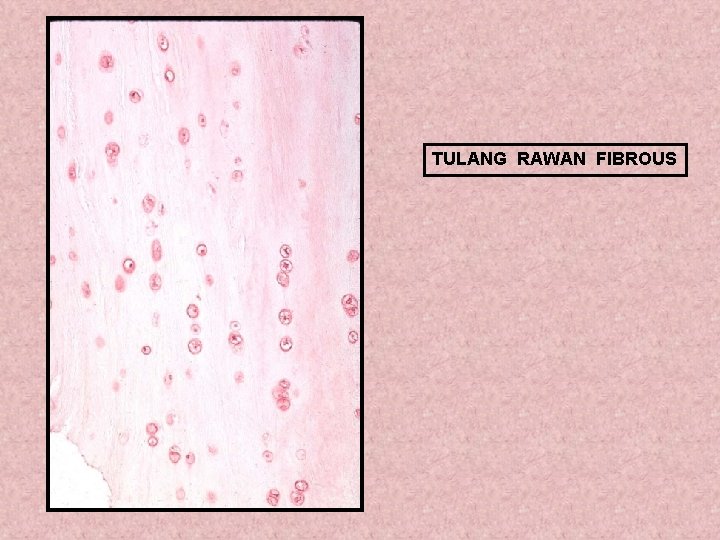 TULANG RAWAN FIBROUS 