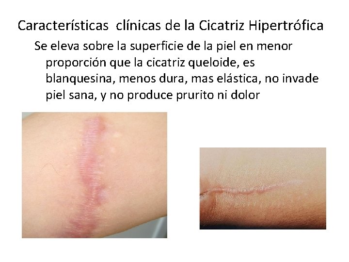 Características clínicas de la Cicatriz Hipertrófica CICATRIZACION PATOLOGICA Se eleva sobre la superficie de