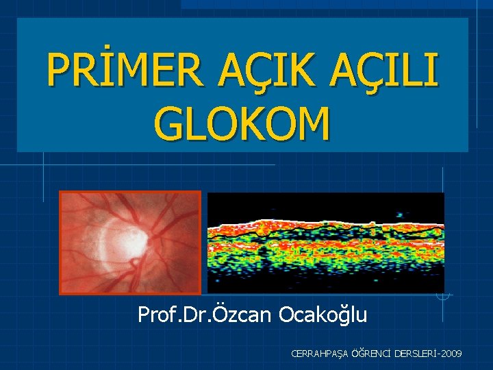 PRİMER AÇIK AÇILI GLOKOM Prof. Dr. Özcan Ocakoğlu CERRAHPAŞA ÖĞRENCİ DERSLERİ-2009 