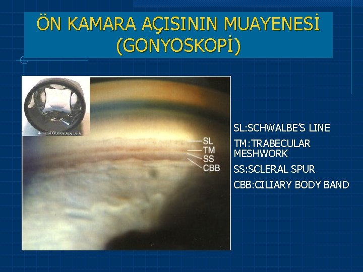 ÖN KAMARA AÇISININ MUAYENESİ (GONYOSKOPİ) SL: SCHWALBE’S LINE TM: TRABECULAR MESHWORK SS: SCLERAL SPUR