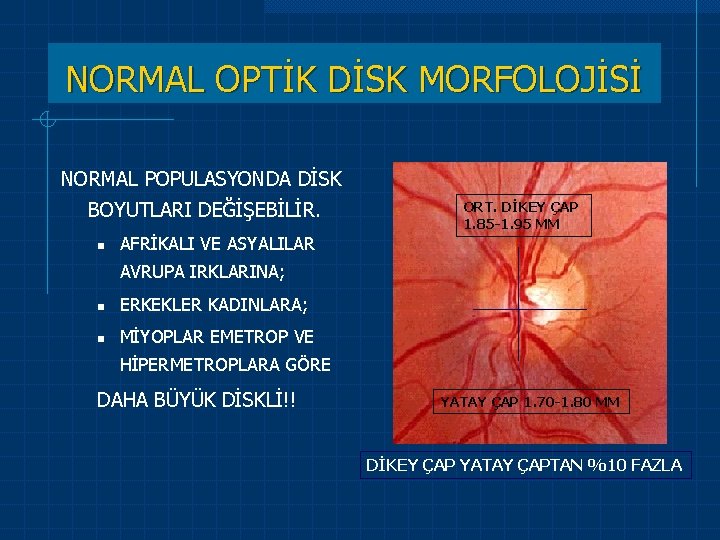 NORMAL OPTİK DİSK MORFOLOJİSİ NORMAL POPULASYONDA DİSK BOYUTLARI DEĞİŞEBİLİR. n ORT. DİKEY ÇAP 1.