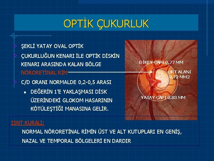 OPTİK ÇUKURLUK ŞEKLİ YATAY OVAL OPTİK ÇUKURLUĞUN KENARI İLE OPTİK DİSKİN KENARI ARASINDA KALAN