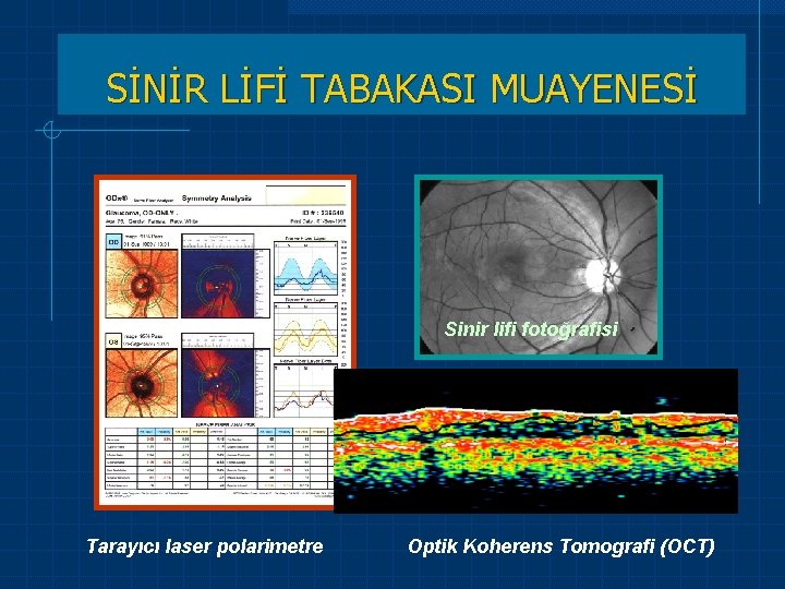 SİNİR LİFİ TABAKASI MUAYENESİ Sinir lifi fotoğrafisi Tarayıcı laser polarimetre Optik Koherens Tomografi (OCT)