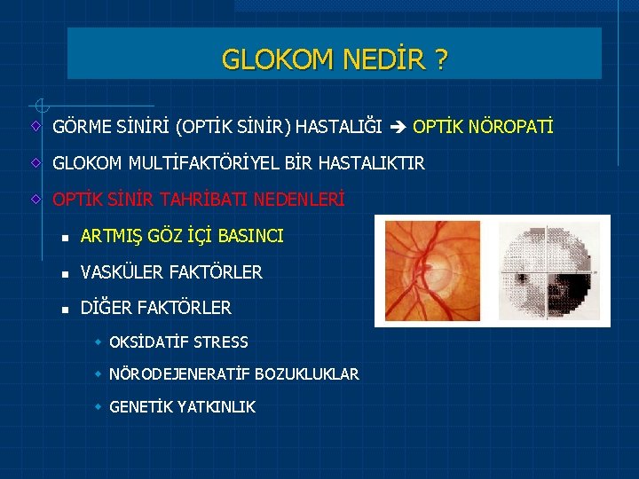 GLOKOM NEDİR ? GÖRME SİNİRİ (OPTİK SİNİR) HASTALIĞI OPTİK NÖROPATİ GLOKOM MULTİFAKTÖRİYEL BİR HASTALIKTIR