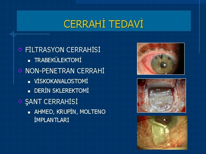 CERRAHİ TEDAVİ FİLTRASYON CERRAHİSİ n TRABEKÜLEKTOMİ NON-PENETRAN CERRAHİ n VİSKOKANALOSTOMİ n DERİN SKLEREKTOMİ ŞANT