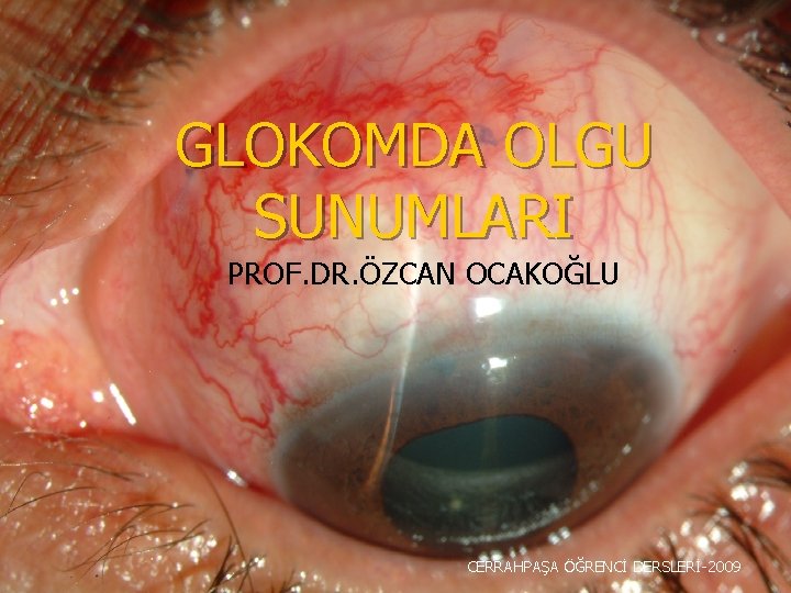 GLOKOMDA OLGU SUNUMLARI PROF. DR. ÖZCAN OCAKOĞLU CERRAHPAŞA ÖĞRENCİ DERSLERİ-2009 