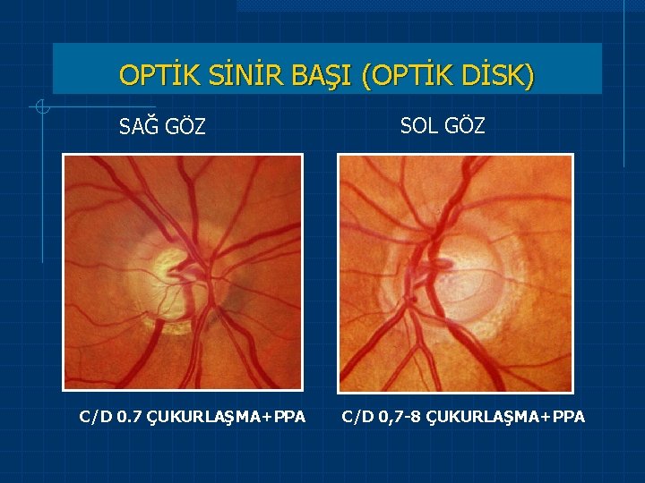 OPTİK SİNİR BAŞI (OPTİK DİSK) SAĞ GÖZ C/D 0. 7 ÇUKURLAŞMA+PPA SOL GÖZ C/D