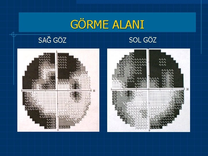 GÖRME ALANI SAĞ GÖZ SOL GÖZ 