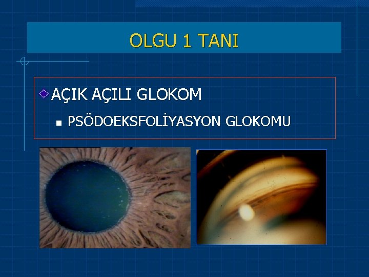 OLGU 1 TANI AÇIK AÇILI GLOKOM n PSÖDOEKSFOLİYASYON GLOKOMU 