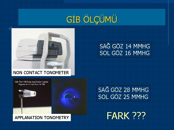 NON CONTACT TONOMETER APPLANATION TONOMETRY GİB ÖLÇÜMÜ SAĞ GÖZ 14 MMHG SOL GÖZ NON CONTACT TONOMETER APPLANATION TONOMETRY GİB ÖLÇÜMÜ SAĞ GÖZ 14 MMHG SOL GÖZ