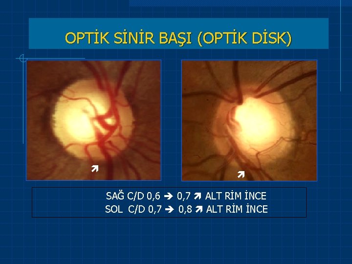 OPTİK SİNİR BAŞI (OPTİK DİSK) SAĞ C/D 0, 6 0, 7 ALT RİM İNCE OPTİK SİNİR BAŞI (OPTİK DİSK) SAĞ C/D 0, 6 0, 7 ALT RİM İNCE
