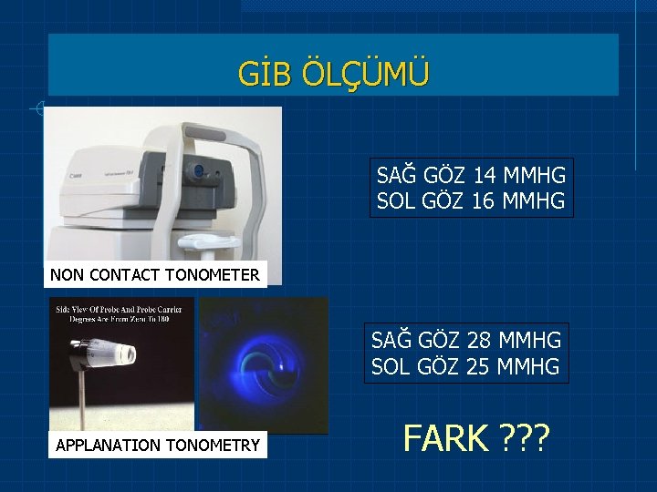  NON CONTACT TONOMETER APPLANATION TONOMETRY GİB ÖLÇÜMÜ SAĞ GÖZ 14 MMHG SOL GÖZ