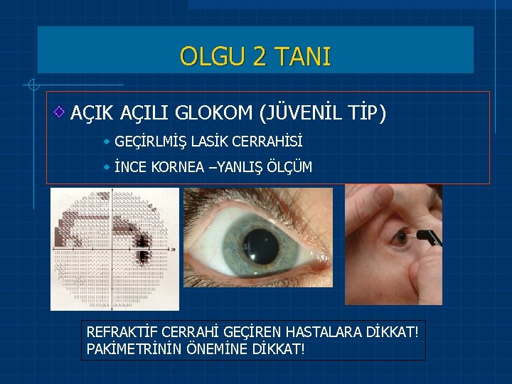 OLGU 2 TANI AÇIK AÇILI GLOKOM (JÜVENİL TİP) w GEÇİRLMİŞ LASİK CERRAHİSİ w İNCE