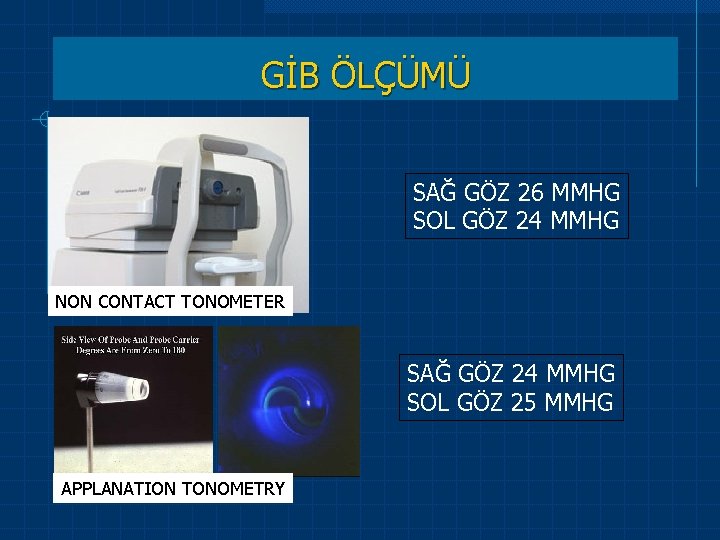  NON CONTACT TONOMETER APPLANATION TONOMETRY GİB ÖLÇÜMÜ SAĞ GÖZ 26 MMHG SOL GÖZ