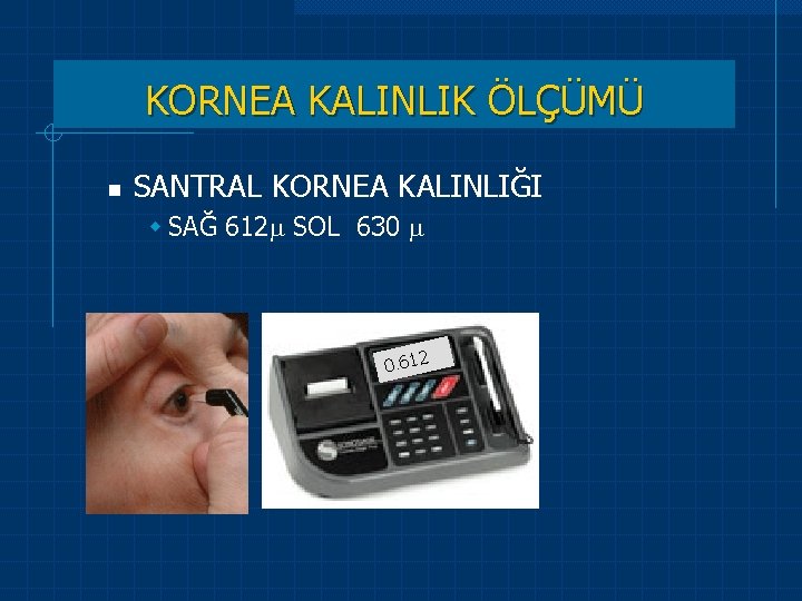 KORNEA KALINLIK ÖLÇÜMÜ n SANTRAL KORNEA KALINLIĞI w SAĞ 612 SOL 630 0. 612