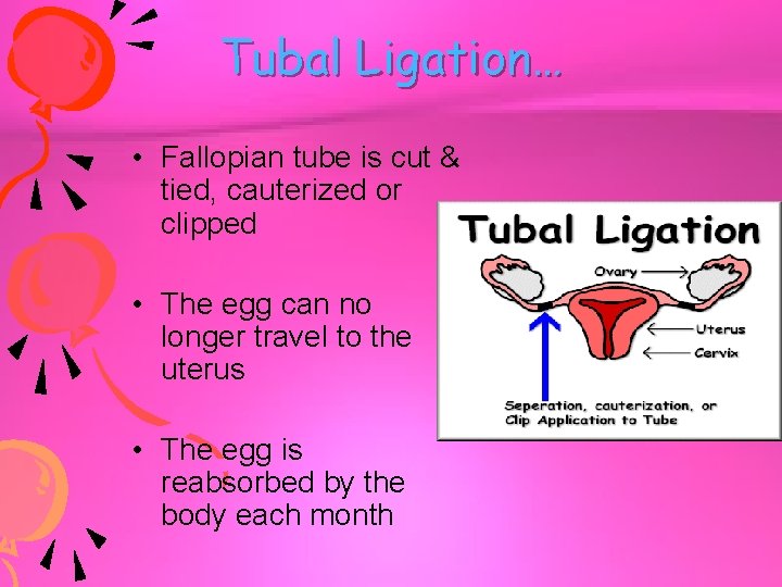 Tubal Ligation… • Fallopian tube is cut & tied, cauterized or clipped • The