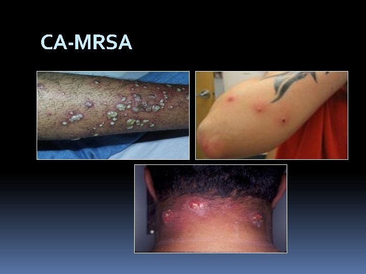 CA-MRSA 