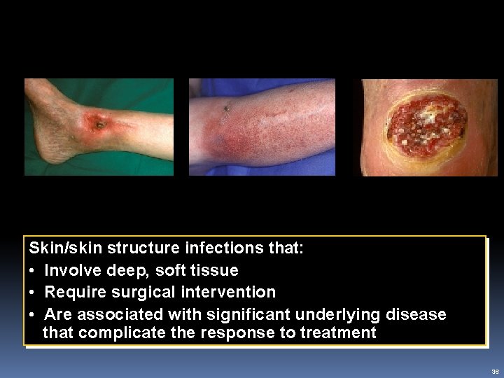 c. SSSI Definition Abscess Cellulitis Ulcer Skin/skin structure infections that: • Involve deep, soft