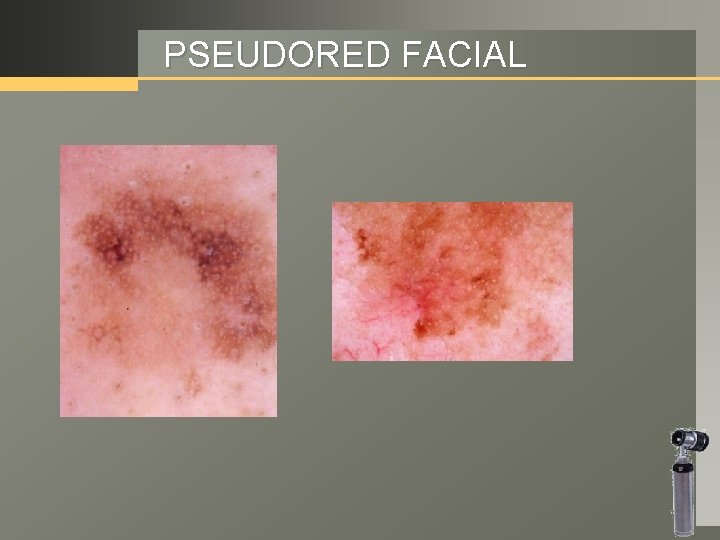 PSEUDORED FACIAL 