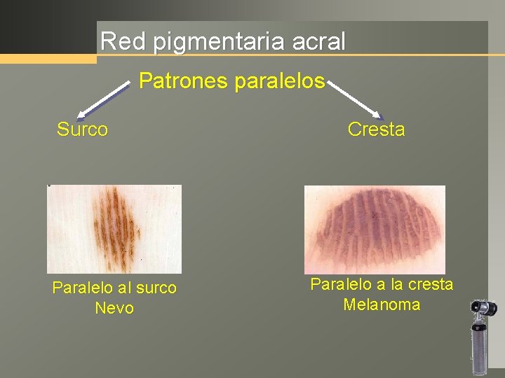 Red pigmentaria acral Patrones paralelos Surco Paralelo al surco Nevo Cresta Paralelo a la