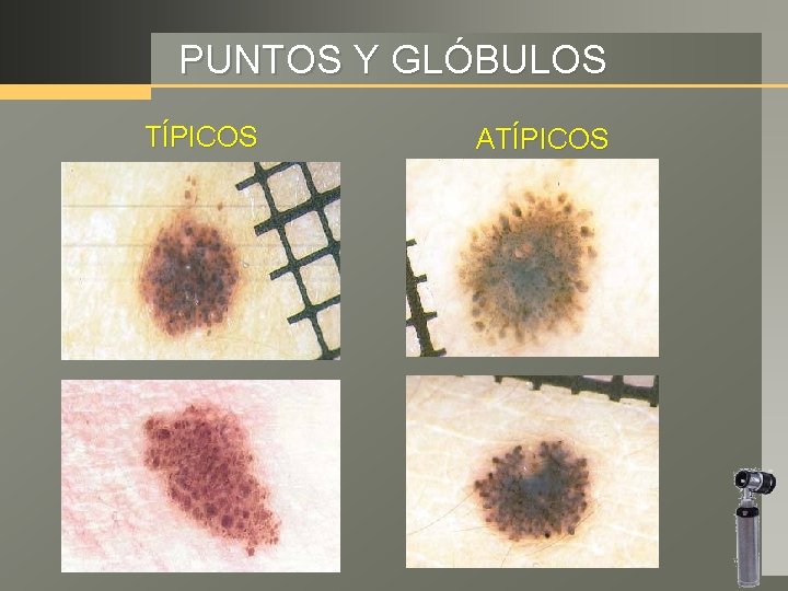 PUNTOS Y GLÓBULOS TÍPICOS ATÍPICOS 