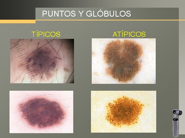 PUNTOS Y GLÓBULOS TÍPICOS ATÍPICOS 