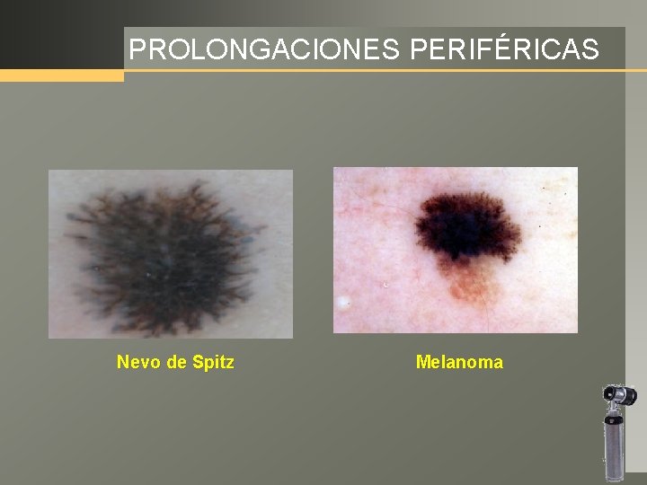 PROLONGACIONES PERIFÉRICAS Nevo de Spitz Melanoma 