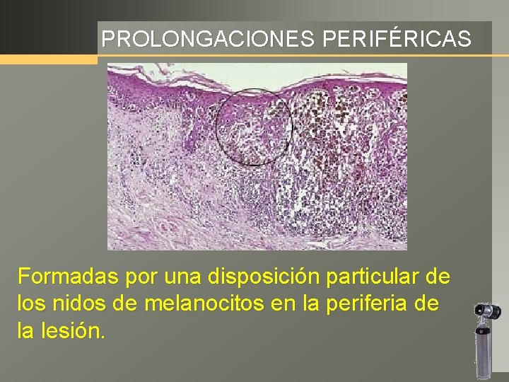 PROLONGACIONES PERIFÉRICAS Formadas por una disposición particular de los nidos de melanocitos en la