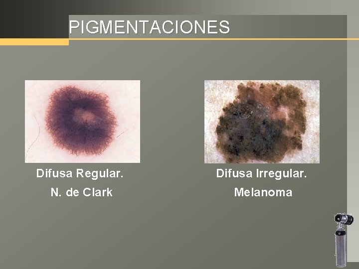 PIGMENTACIONES Difusa Regular. Difusa Irregular. N. de Clark Melanoma 