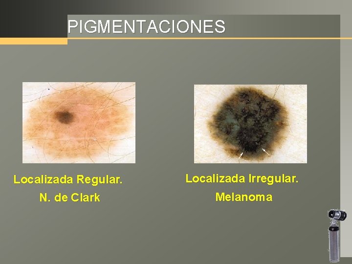 PIGMENTACIONES Localizada Regular. Localizada Irregular. N. de Clark Melanoma 