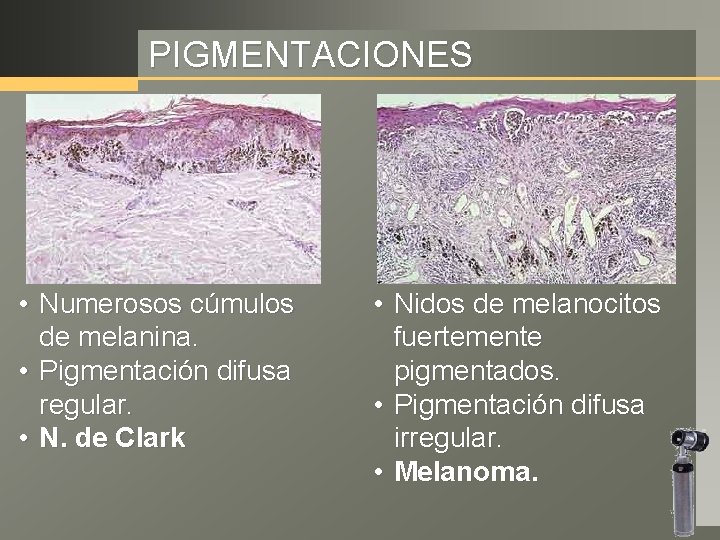 PIGMENTACIONES • Numerosos cúmulos de melanina. • Pigmentación difusa regular. • N. de Clark