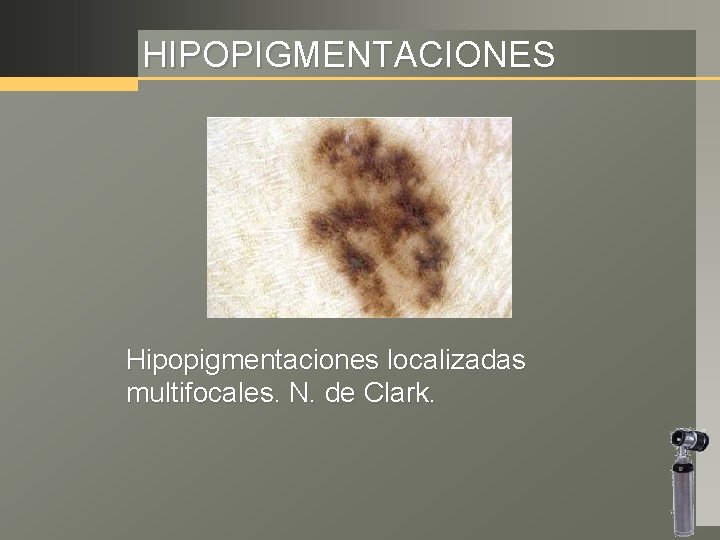 HIPOPIGMENTACIONES Hipopigmentaciones localizadas multifocales. N. de Clark. 