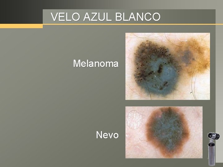 VELO AZUL BLANCO Melanoma Nevo 