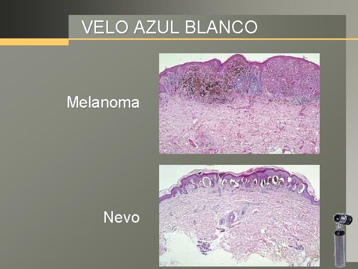 VELO AZUL BLANCO Melanoma Nevo 