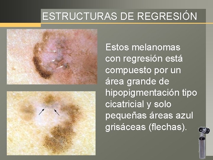 ESTRUCTURAS DE REGRESIÓN Estos melanomas con regresión está compuesto por un área grande de