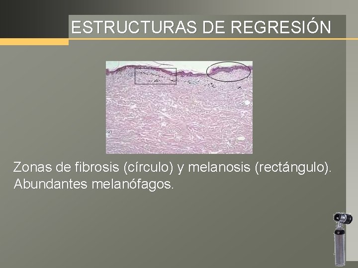 ESTRUCTURAS DE REGRESIÓN Zonas de fibrosis (círculo) y melanosis (rectángulo). Abundantes melanófagos. 